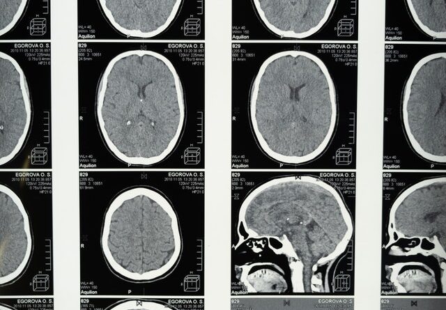 People with depression can sometimes experience memory problems – here’s why